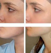 做激光除皱果如何