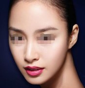 隆鼻假体可以取出么