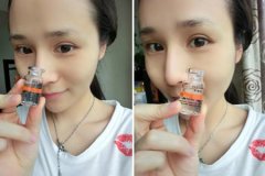 埋线双眼皮拆线后几天可以重新做