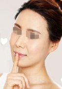 发际线种植会不会受年龄影响 发际线种植会不会受年龄影响