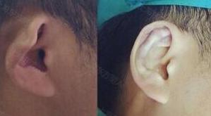 招风耳矫正,方式,有哪些