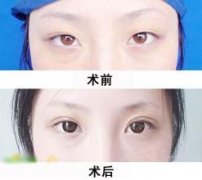 失败眼部整形美容手术修复