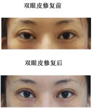 失败眼部整形美容手术修复