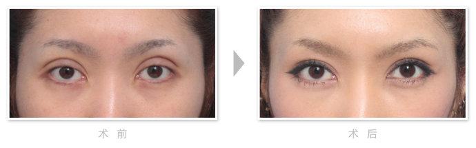 失败眼部整形美容手术修复