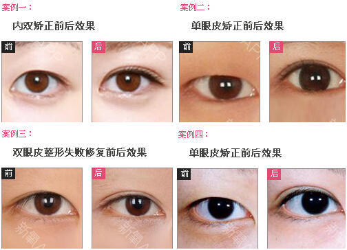 修复失败眼部整形美容手术