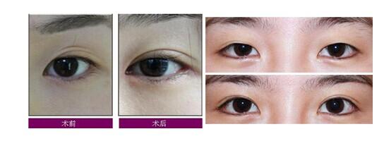 修复失败眼部整形美容手术