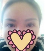 双眼皮修复手术方法