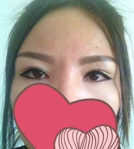 双眼皮修复手术方法
