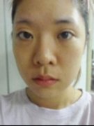 双眼皮手术修复方法