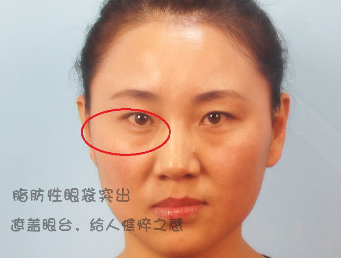 眼袋型的形成原因及其处理办法
