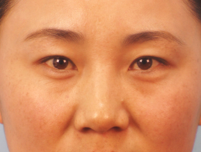 眼袋型的形成原因及其处理办法