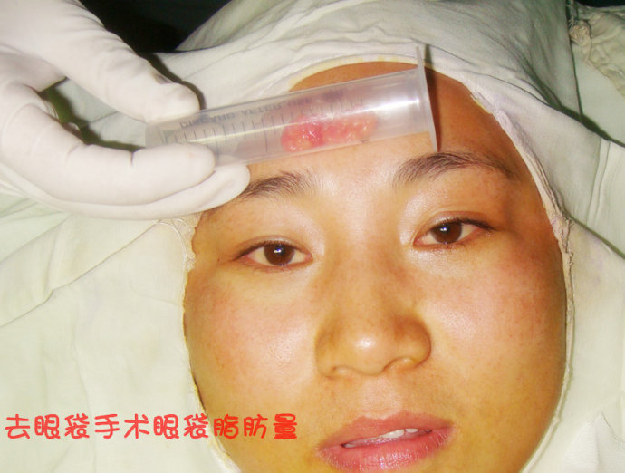 眼袋型的形成原因及其处理办法