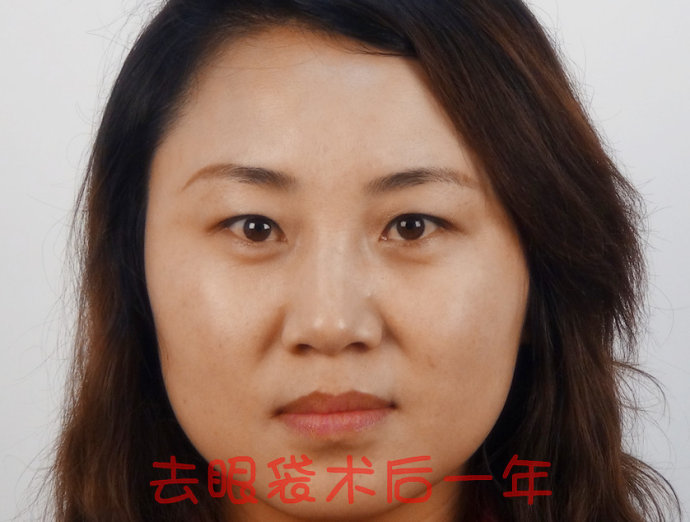 眼袋型的形成原因及其处理办法