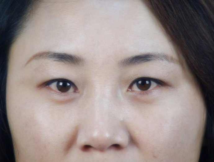 眼袋型的形成原因及其处理办法