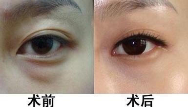 眼袋整形手术分类