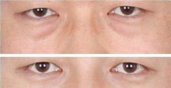 眼袋整形手术分类 眼袋整形手术分类