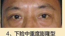 眼袋整形手术分类