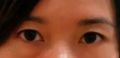 眼袋切除术图片 眼袋切除术图片