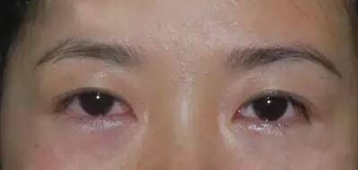眼袋切除术图片