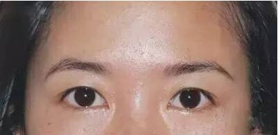 眼袋切除术图片