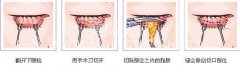 切除眼袋有几种方法 切除眼袋有几种方法