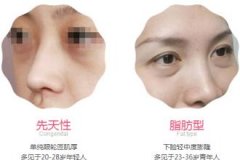 眼袋形成的原因是什么 眼袋形成的原因是什么