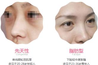眼袋形成的原因是什么