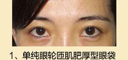 手术去眼袋的方法有哪些