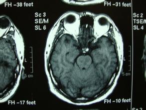 眼睑下垂有哪些症状