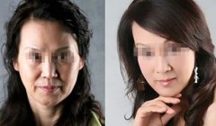 电波l皮除皱有哪些优势