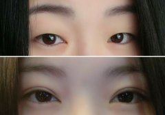 双眼皮几天能恢复