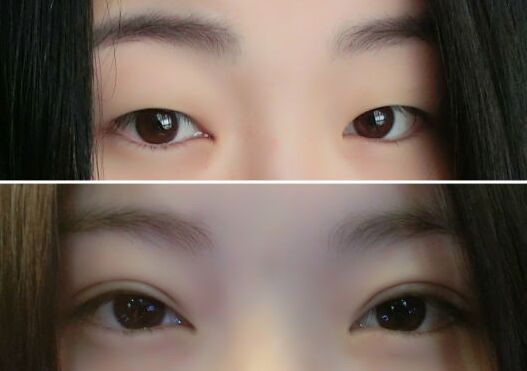 双眼皮几天能恢复