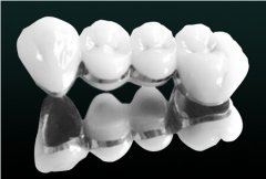 烤瓷牙会变色吗