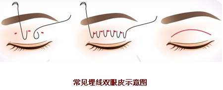 埋线双眼皮,消肿快,方法,有哪些