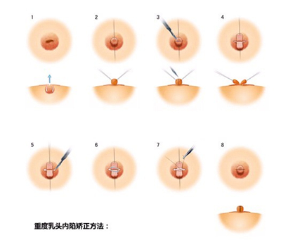 乳头内陷,影响,哺乳,怎么办