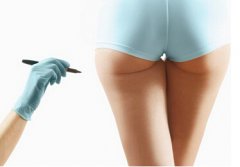 自体脂肪丰臀原理 果怎么样