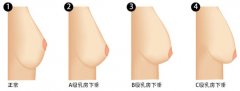 胸下垂的原因及程度