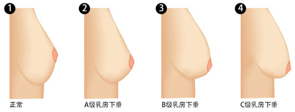 胸下垂,原因,程度