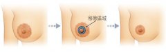 乳头乳晕缩小后的果怎么样