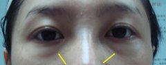 手术去除眼袋图片 手术去除眼袋图片