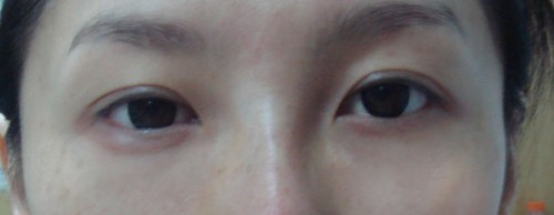 手术去除眼袋图片