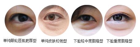快速简单的去除眼袋的方法有哪些呢