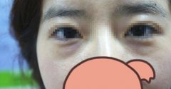 手术去除黑眼圈眼袋 手术去除黑眼圈眼袋