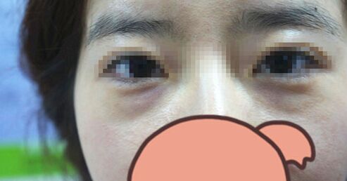 手术去除黑眼圈眼袋