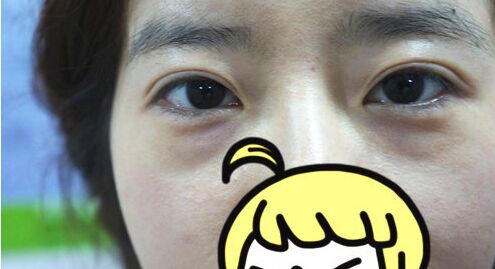 手术去除黑眼圈眼袋