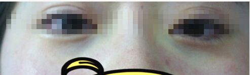 手术去除黑眼圈眼袋