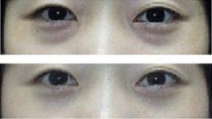 去眼袋手术如何去眼袋 去眼袋手术如何去眼袋