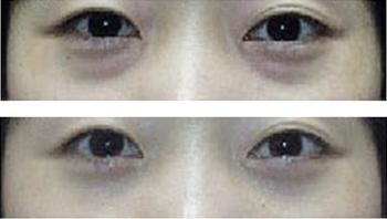 去眼袋手术如何去眼袋
