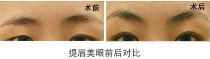 眉毛上提图片