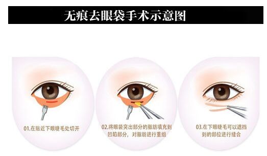 眼袋形成的原因有哪些 用喜欢的方法消除眼袋